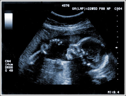 Ultrasound image.
