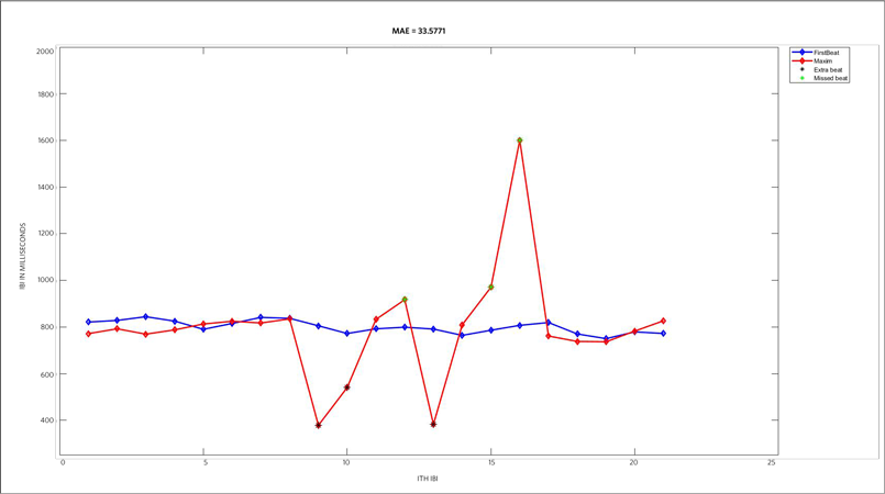 Figure 3. Missing and extra beat illustrated on tachogram.