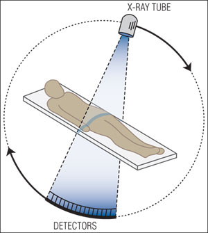 患者に扇形のX線ビームを照射し、薄型、半円形のディジタルX線検出器で投影画像を検出