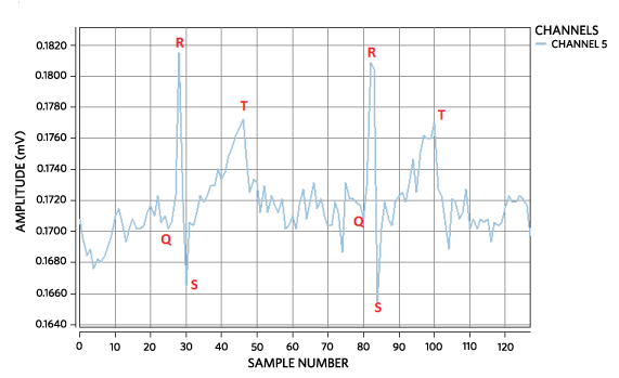 ECG waveform using 1x gain.