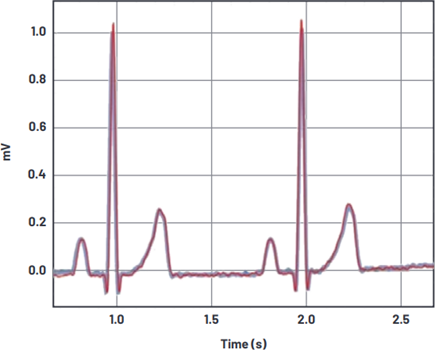 Two ECG waveforms measured with different electrodes